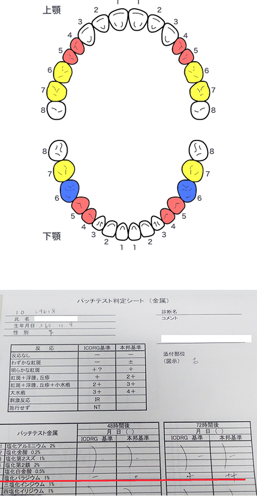 白いかぶせもの