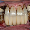 60代男性：重度歯周病咬合再構築