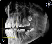 歯科用CT
